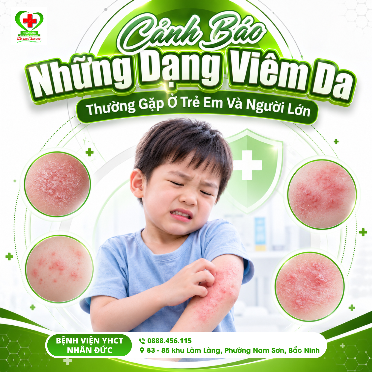 Những dạng viêm da thường gặp ở trẻ em và người lớn