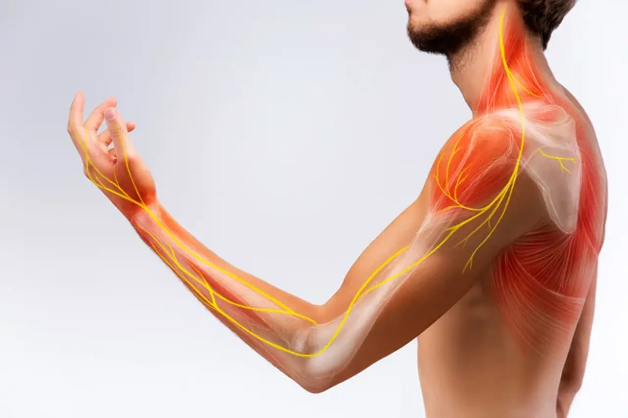 Điều trị hội chứng cổ vai cánh tay