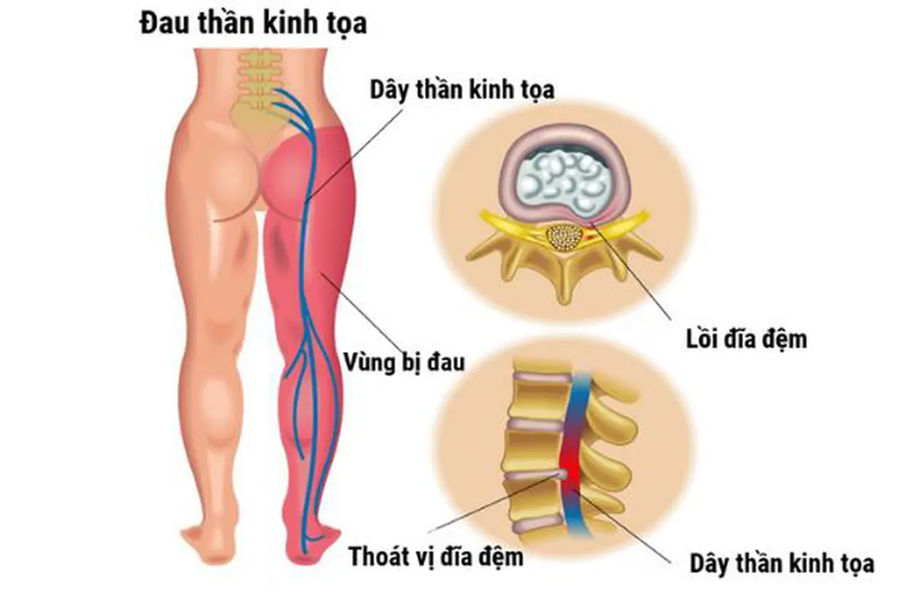 Điều trị đau thần kinh tọa