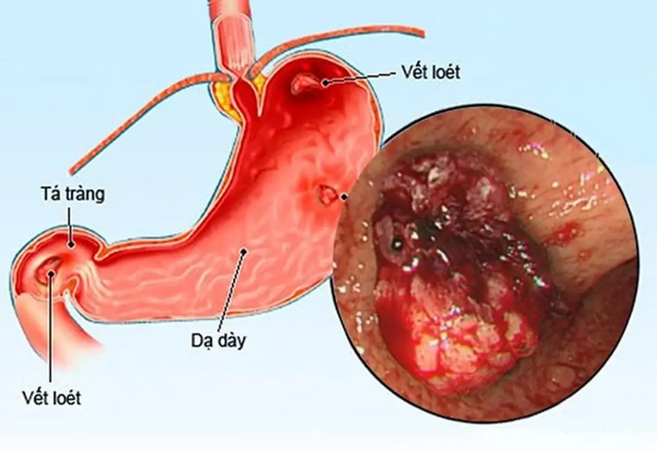 Điều trị viêm dạ dày