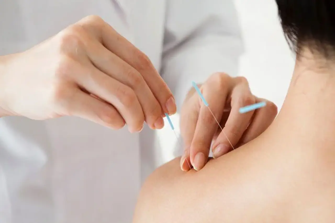 Châm cứu điều trị đau vai gáy