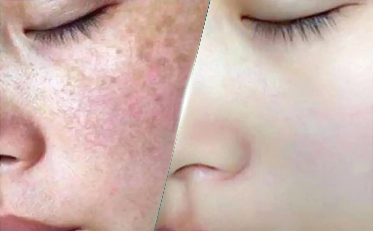 Điều trị nám