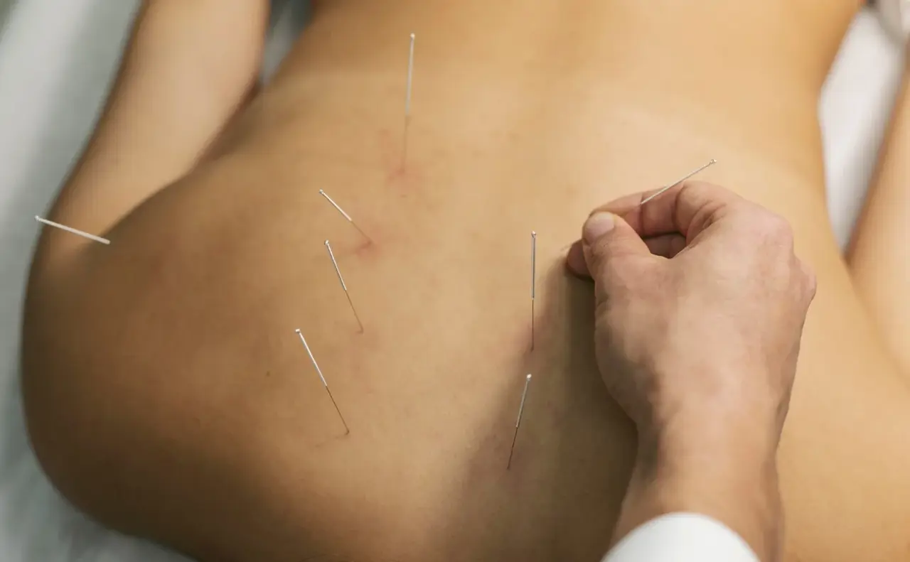 Điều trị mất ngủ bằng châm cứu
